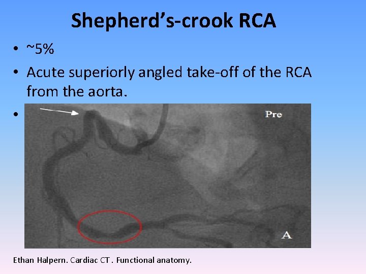 Shepherd’s-crook RCA • ~5% • Acute superiorly angled take-off of the RCA from the