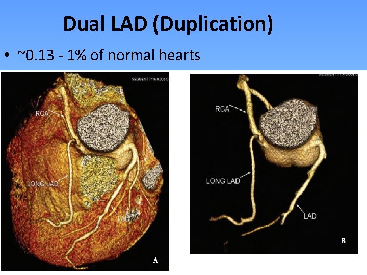Dual LAD (Duplication) • ~0. 13 - 1% of normal hearts • Proximal LAD