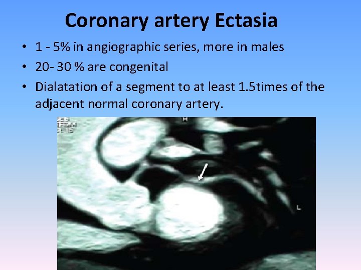 Coronary artery Ectasia • 1 - 5% in angiographic series, more in males •
