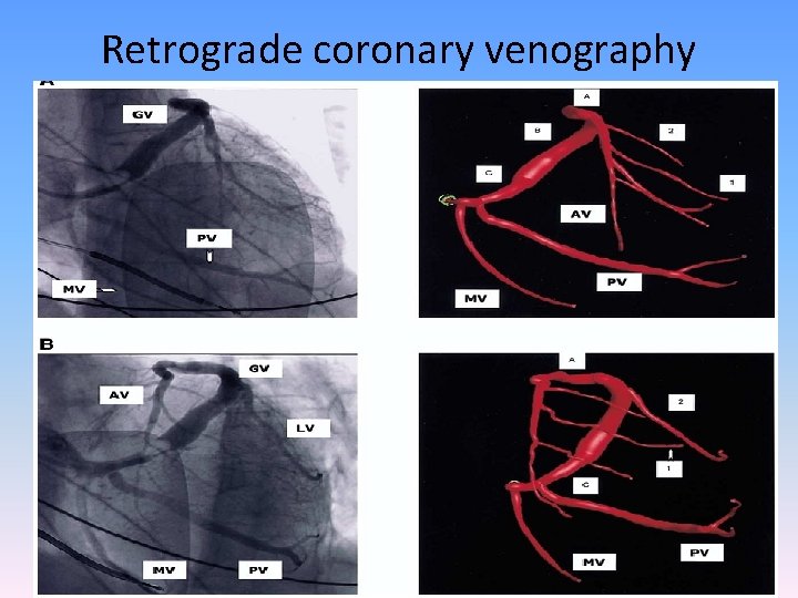 Retrograde coronary venography 