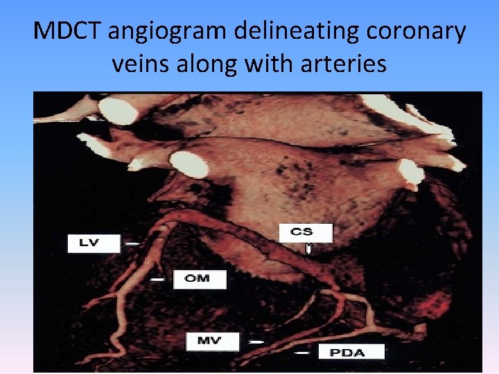 MDCT angiogram delineating coronary veins along with arteries 