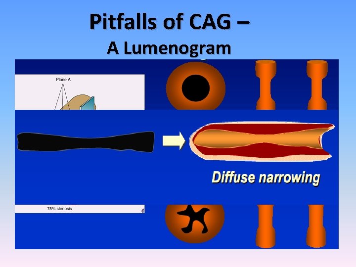 Pitfalls of CAG – A Lumenogram 