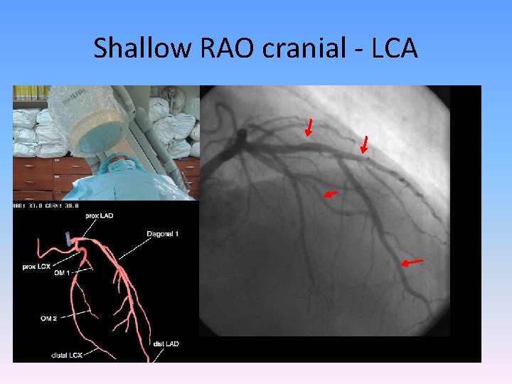 Shallow RAO cranial - LCA 