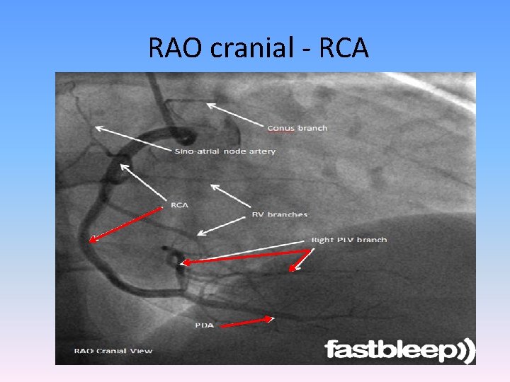 RAO cranial - RCA 