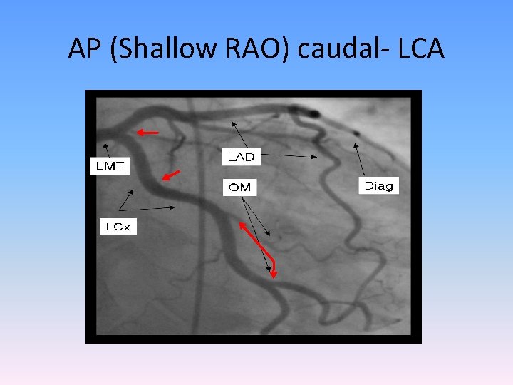 AP (Shallow RAO) caudal- LCA 
