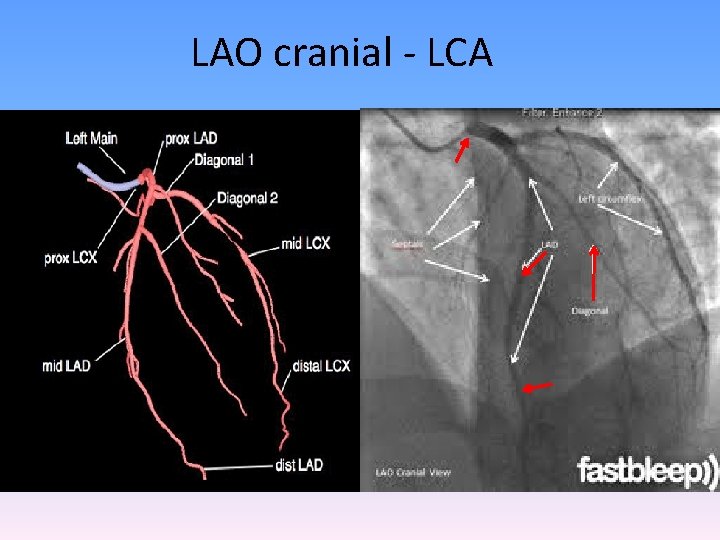 LAO cranial - LCA 