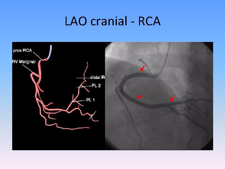 LAO cranial - RCA 