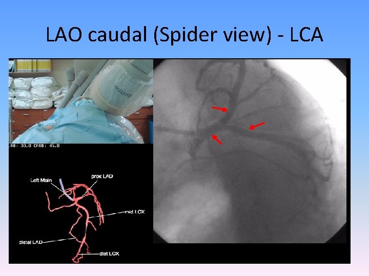 LAO caudal (Spider view) - LCA 