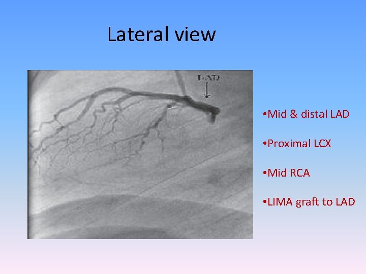 Lateral view • Mid & distal LAD • Proximal LCX • Mid RCA •