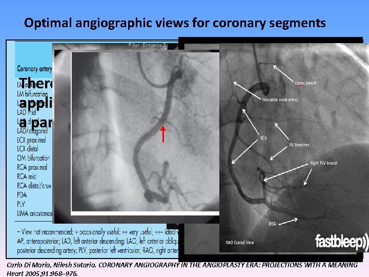 Optimal angiographic views for coronary segments There is no single magical projection that can