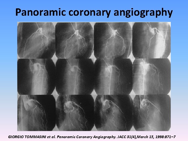 Panoramic coronary angiography GIORGIO TOMMASINI et al. Panoramic Coronary Angiography. JACC 31(4), March 15,