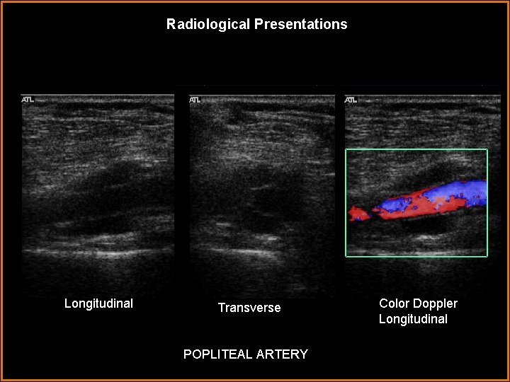 Radiological Presentations Longitudinal Transverse POPLITEAL ARTERY Color Doppler Longitudinal 