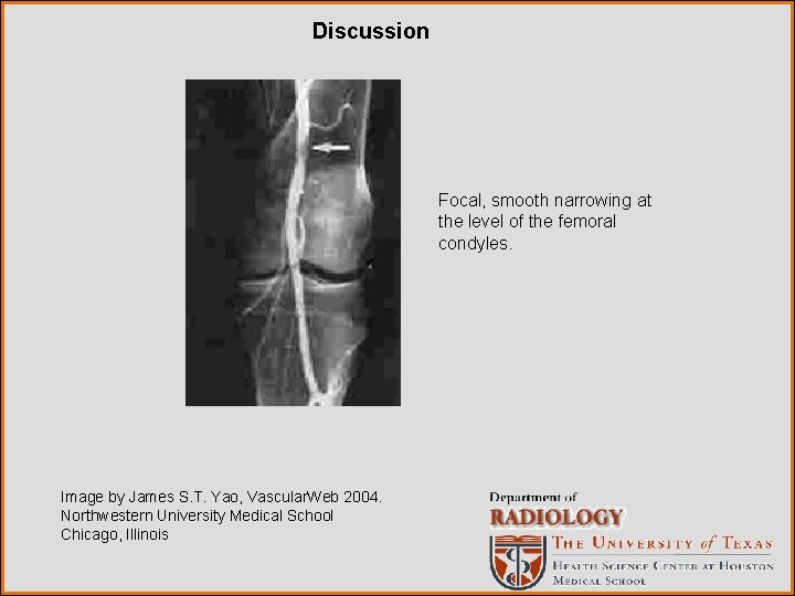 Discussion Focal, smooth narrowing at the level of the femoral condyles. Image by James