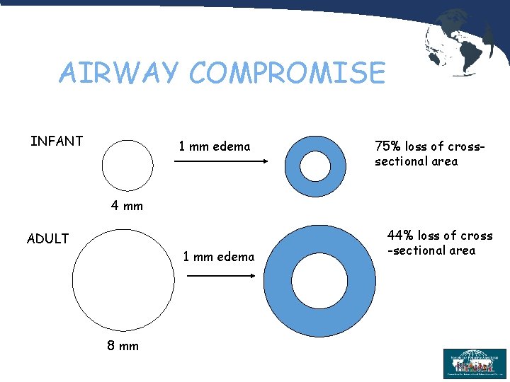 AIRWAY COMPROMISE INFANT 1 mm edema 75% loss of crosssectional area 4 mm ADULT