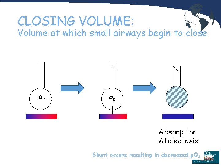 CLOSING VOLUME: Volume at which small airways begin to close O 2 Absorption Atelectasis