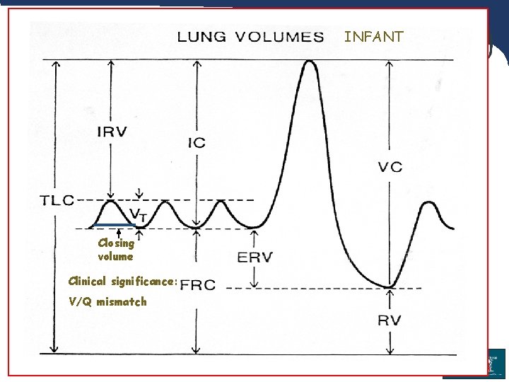 INFANT Closing volume Clinical significance: V/Q mismatch 