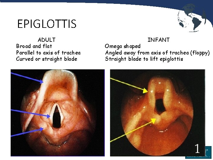 EPIGLOTTIS ADULT Broad and flat Parallel to axis of trachea Curved or straight blade