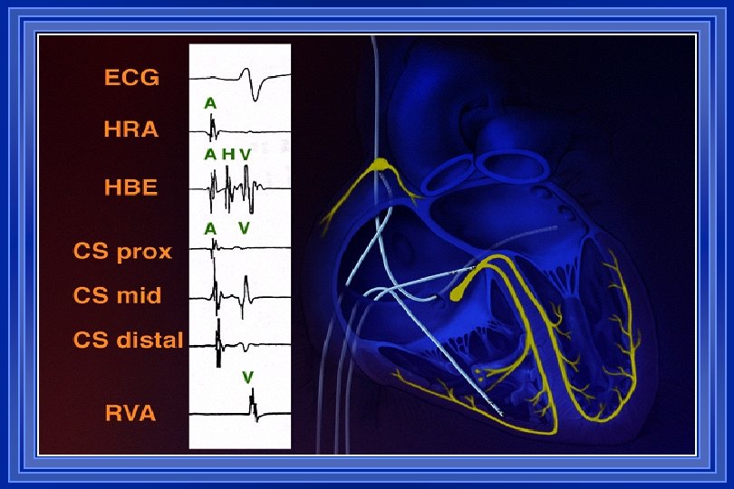 Catheter Placement 