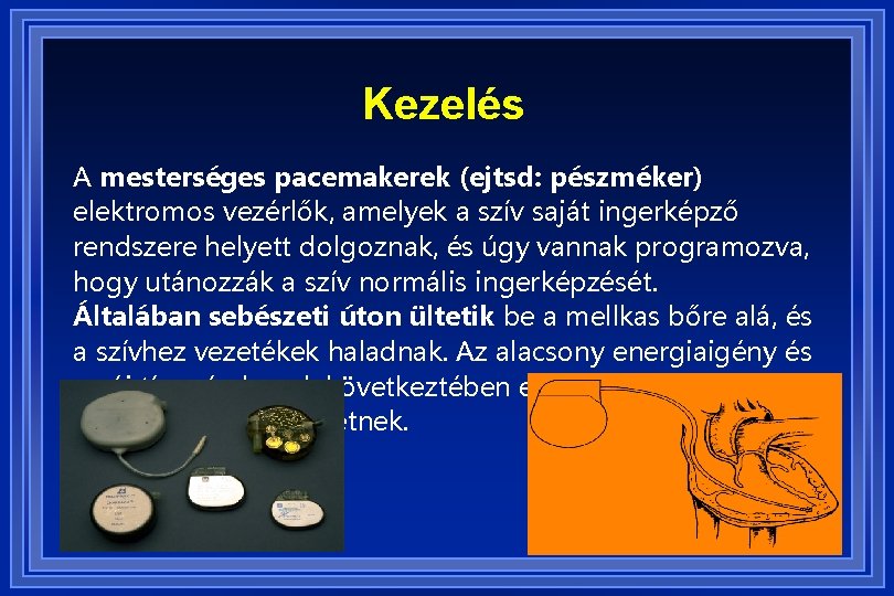 Kezelés A mesterséges pacemakerek (ejtsd: pészméker) elektromos vezérlők, amelyek a szív saját ingerképző rendszere