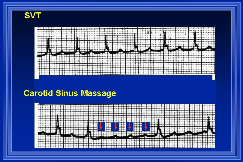 SVT Carotid Sinus Massage 