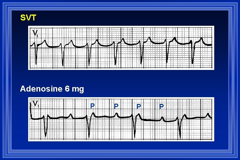 SVT Adenosine 6 mg P P 