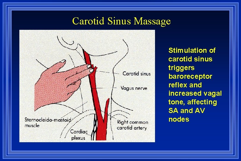 Carotid Sinus Massage Stimulation of carotid sinus triggers baroreceptor reflex and increased vagal tone,