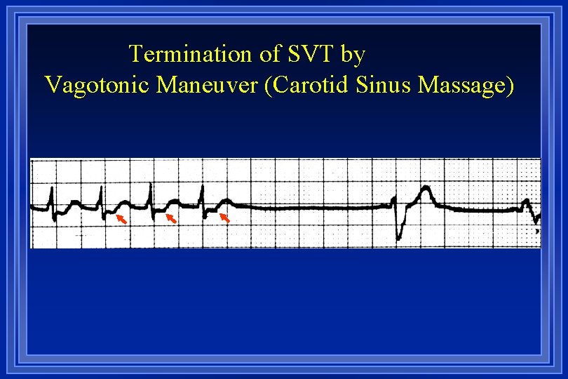 Termination of SVT by Vagotonic Maneuver (Carotid Sinus Massage) 