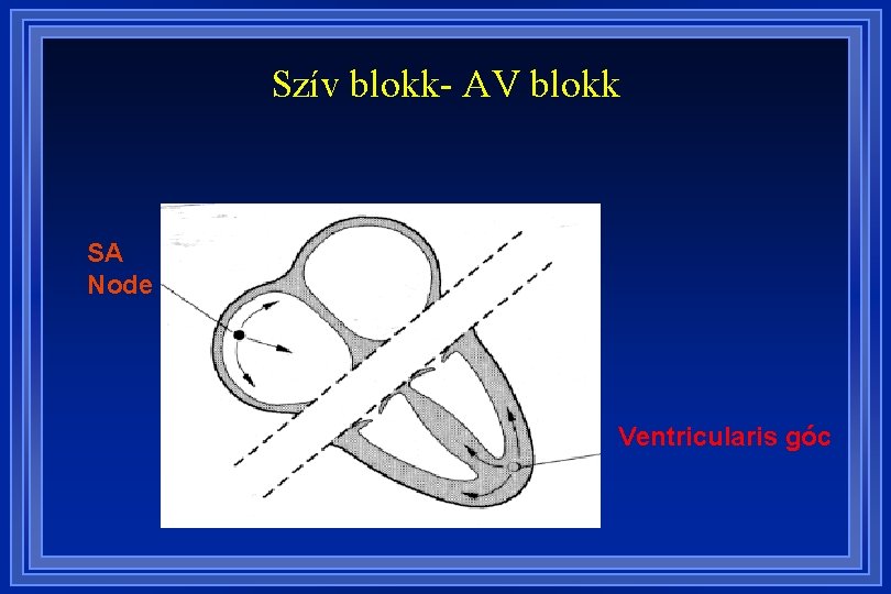 Szív blokk- AV blokk SA Node Ventricularis góc 