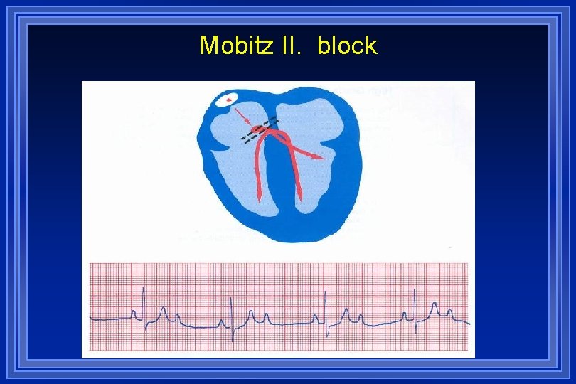 Mobitz II. block 