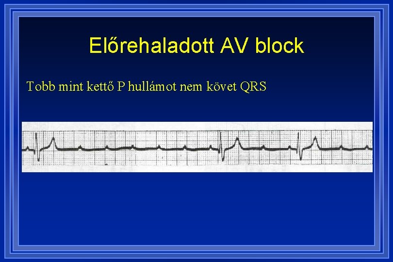 Előrehaladott AV block Tobb mint kettő P hullámot nem követ QRS 