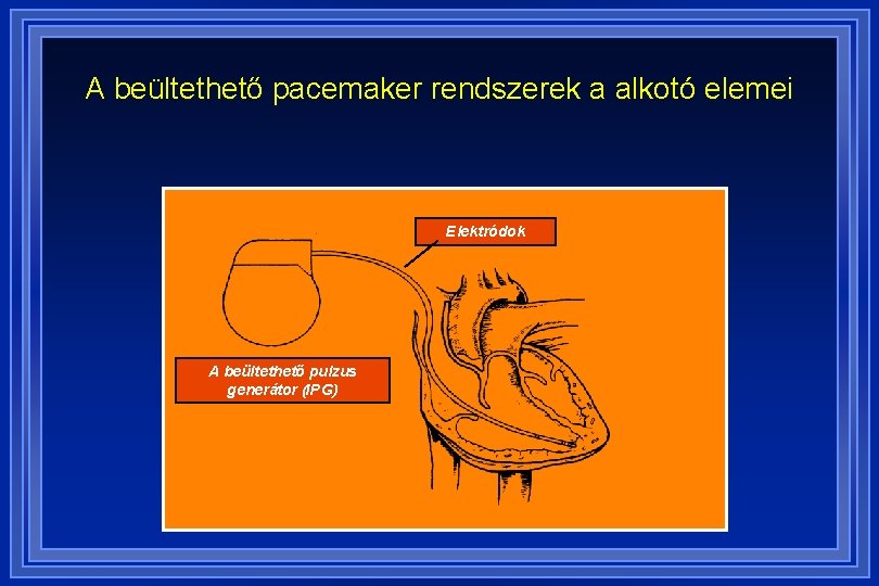 A szívritmus-szabályozó (pacemaker)