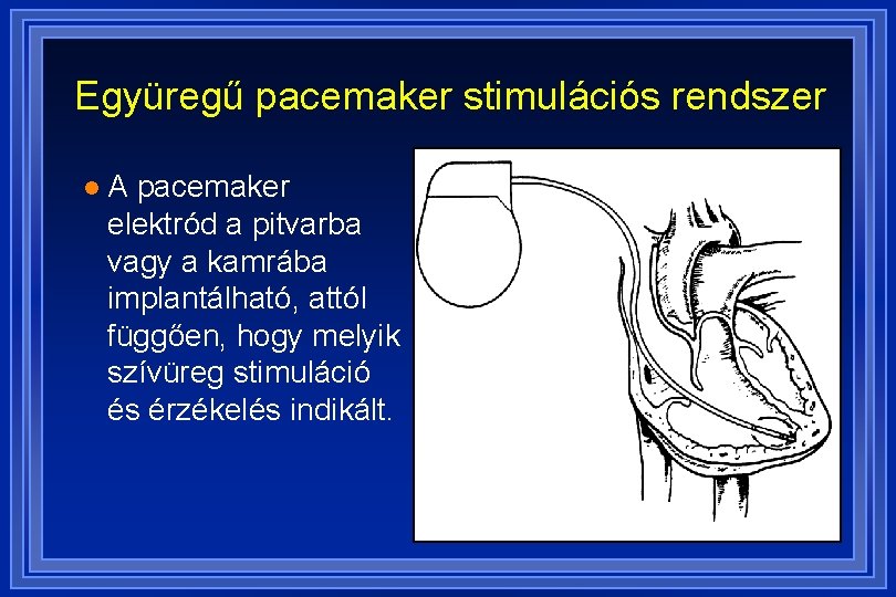 Együregű pacemaker stimulációs rendszer l A pacemaker elektród a pitvarba vagy a kamrába implantálható,