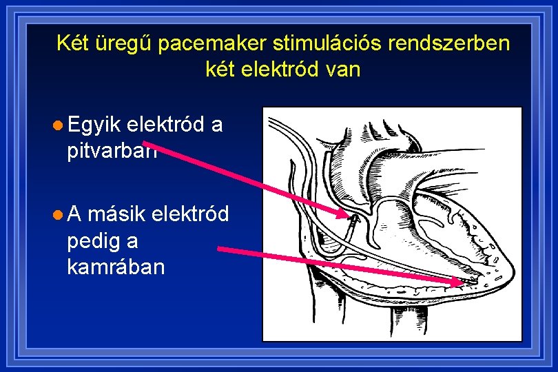 Két üregű pacemaker stimulációs rendszerben két elektród van l Egyik elektród a pitvarban l.