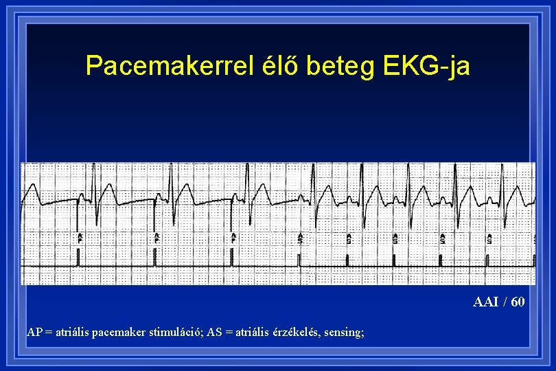A szívritmus-szabályozó (pacemaker)