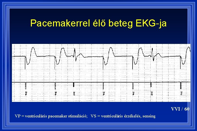 Pacemakerrel élő beteg EKG-ja VVI / 60 VP = ventriculáris pacemaker stimuláció; VS =