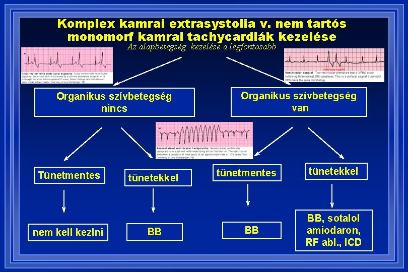 Komplex kamrai extrasystolia v. nem tartós monomorf kamrai tachycardiák kezelése Az alapbetegség kezelése a