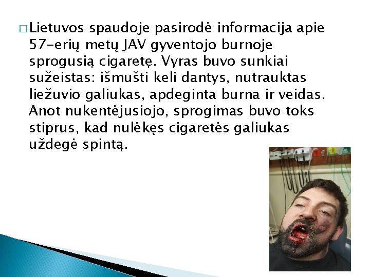 � Lietuvos spaudoje pasirodė informacija apie 57 -erių metų JAV gyventojo burnoje sprogusią cigaretę.
