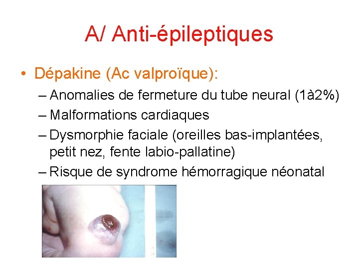 A/ Anti-épileptiques • Dépakine (Ac valproïque): – Anomalies de fermeture du tube neural (1à