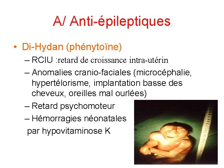 A/ Anti-épileptiques • Di-Hydan (phénytoïne) – RCIU : retard de croissance intra-utérin – Anomalies