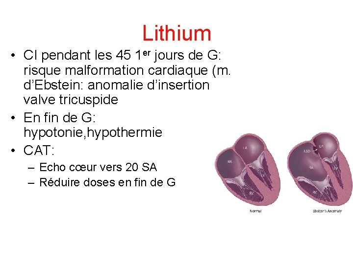 Lithium • CI pendant les 45 1 er jours de G: risque malformation cardiaque