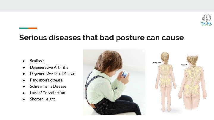 Serious diseases that bad posture can cause ● Scoliosis ● Degenerative Arthritis ● Degenerative