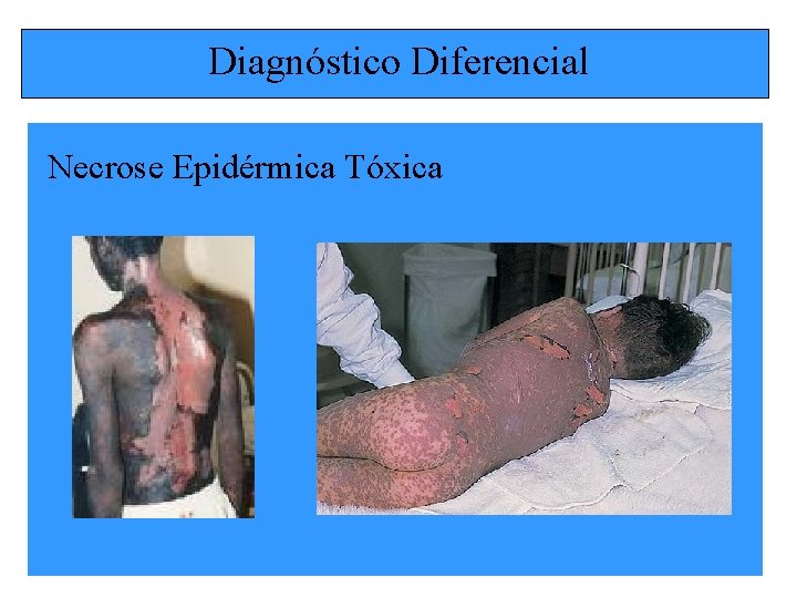 Diagnóstico Diferencial Necrose Epidérmica Tóxica 