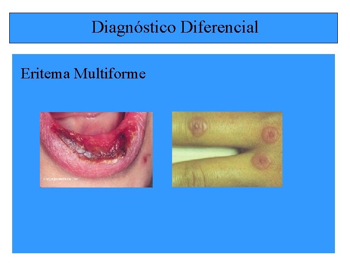 Diagnóstico Diferencial Eritema Multiforme 