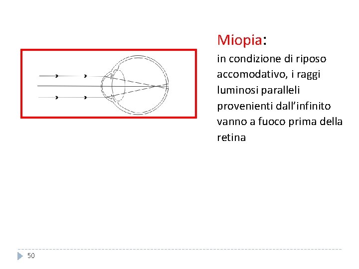 Miopia: in condizione di riposo accomodativo, i raggi luminosi paralleli provenienti dall’infinito vanno a