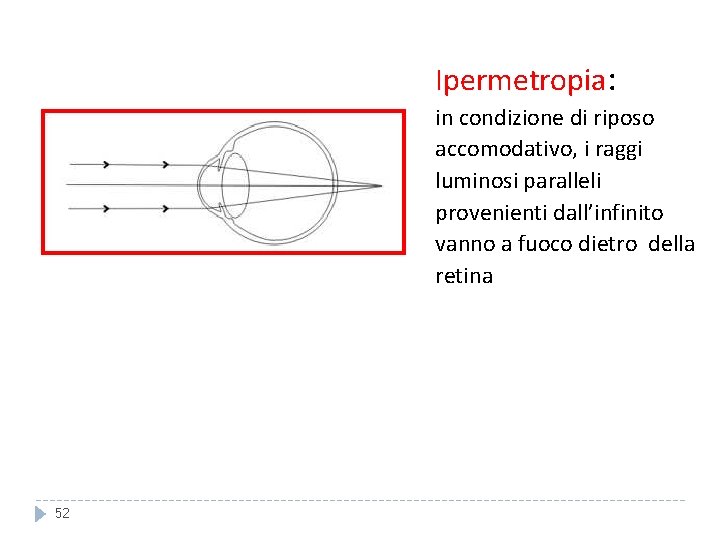 Ipermetropia: in condizione di riposo accomodativo, i raggi luminosi paralleli provenienti dall’infinito vanno a