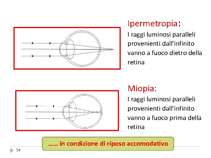 Ipermetropia: I raggi luminosi paralleli provenienti dall’infinito vanno a fuoco dietro della retina Miopia: Ipermetropia: I raggi luminosi paralleli provenienti dall’infinito vanno a fuoco dietro della retina Miopia: