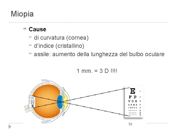 Miopia Cause di curvatura (cornea) d’indice (cristallino) assile: aumento della lunghezza del bulbo oculare