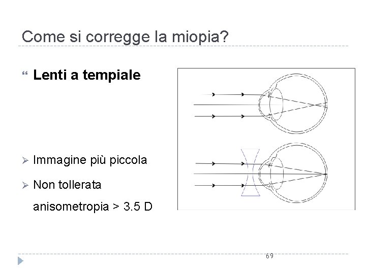 Come si corregge la miopia? Lenti a tempiale Ø Immagine più piccola Ø Non Come si corregge la miopia? Lenti a tempiale Ø Immagine più piccola Ø Non