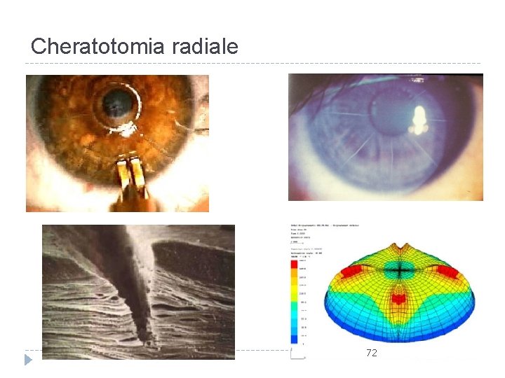 Cheratotomia radiale 72 Cheratotomia radiale 72