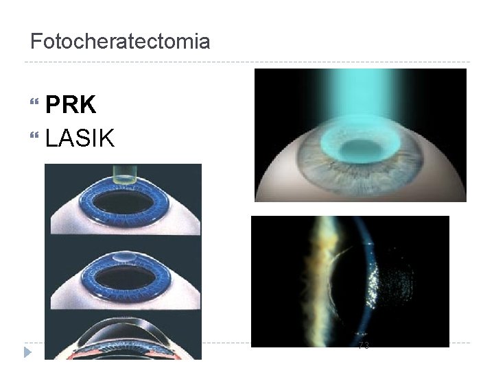 Fotocheratectomia PRK LASIK 73 